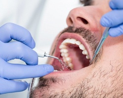 bearded man getting a dental cleaning