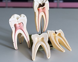 Models of the insides of healthy and unhealthy teeth