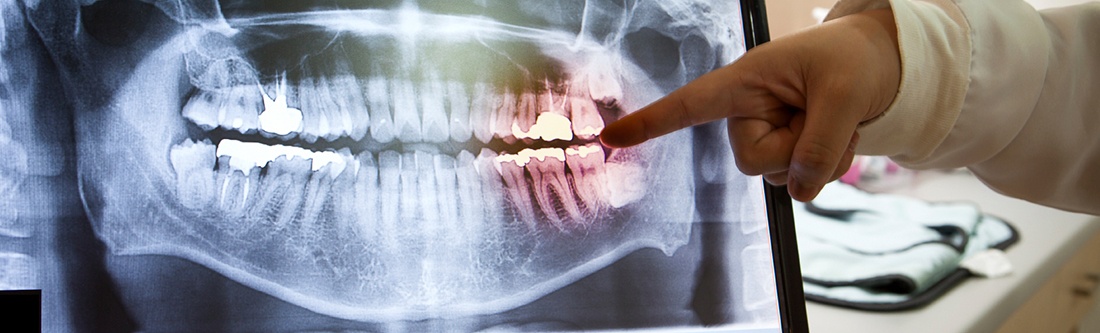 Panoramic dental x-rays on computer