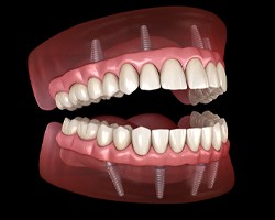 model of All-on-4 dental implants