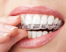 Closeup of patient placing clear aligner