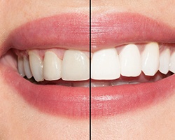 Closeup of teeth half before and half after whitening