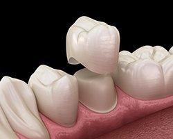 diagram of dental crown being placed on tooth