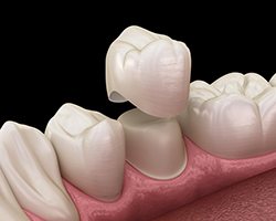 diagram of dental crown being placed on tooth 