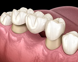 diagram of dental bridge being placed on tooth