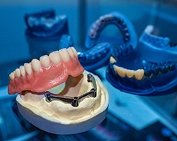 Model of implant-retained dentures