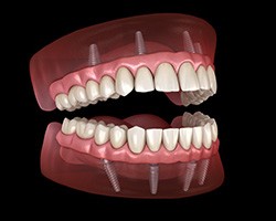 Illustration of implant dentures
