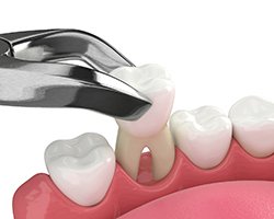 Illustration of a tooth extraction