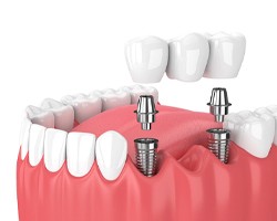 Model of implant-retained bridge