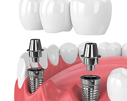 two dental implants supporting a dental bridge 