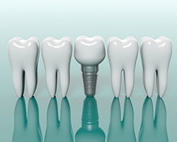 dental implant in between several real teeth 