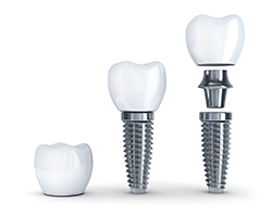 dental implant crown, abutment, and post