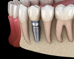 dental implant in the lower jaw 