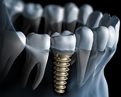 Animation of implant retained dental crown