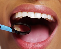 Closeup of teeth during dental exam