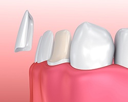 diagram of veneer being placed on tooth
