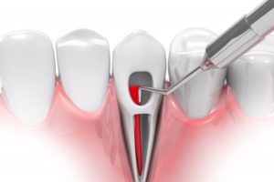 an image of an infected tooth that needs root canal therapy