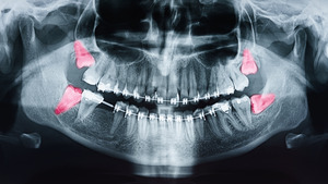 x-ray of an impacted wisdom tooth